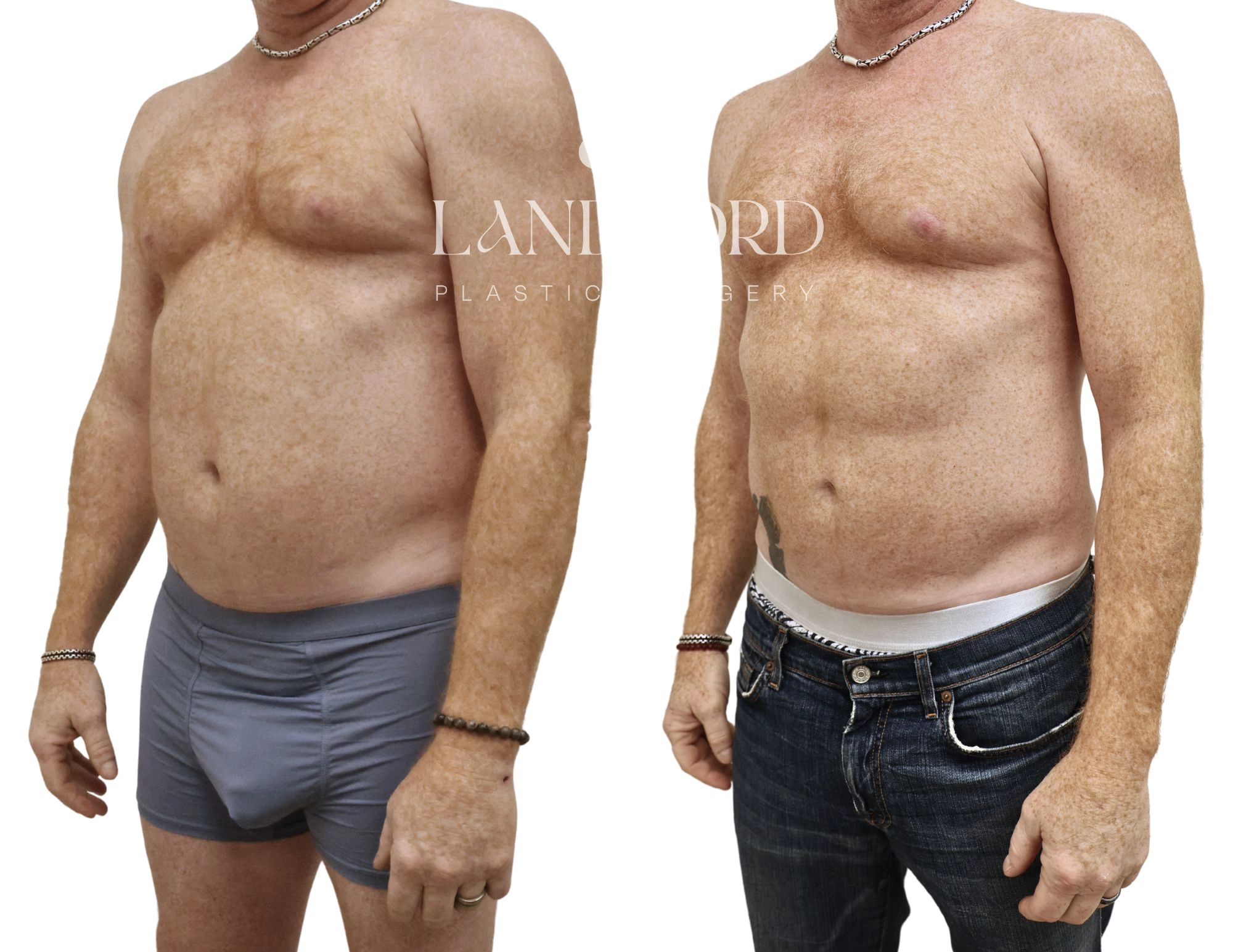 High Definition Liposuction