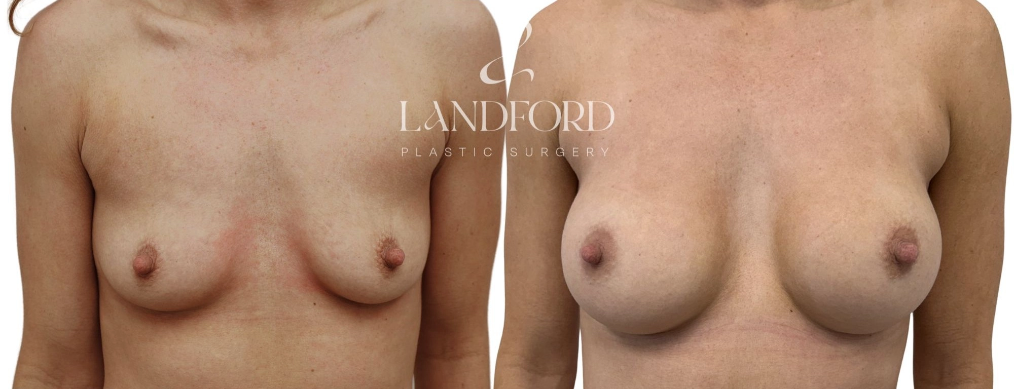 Breast Augmentation