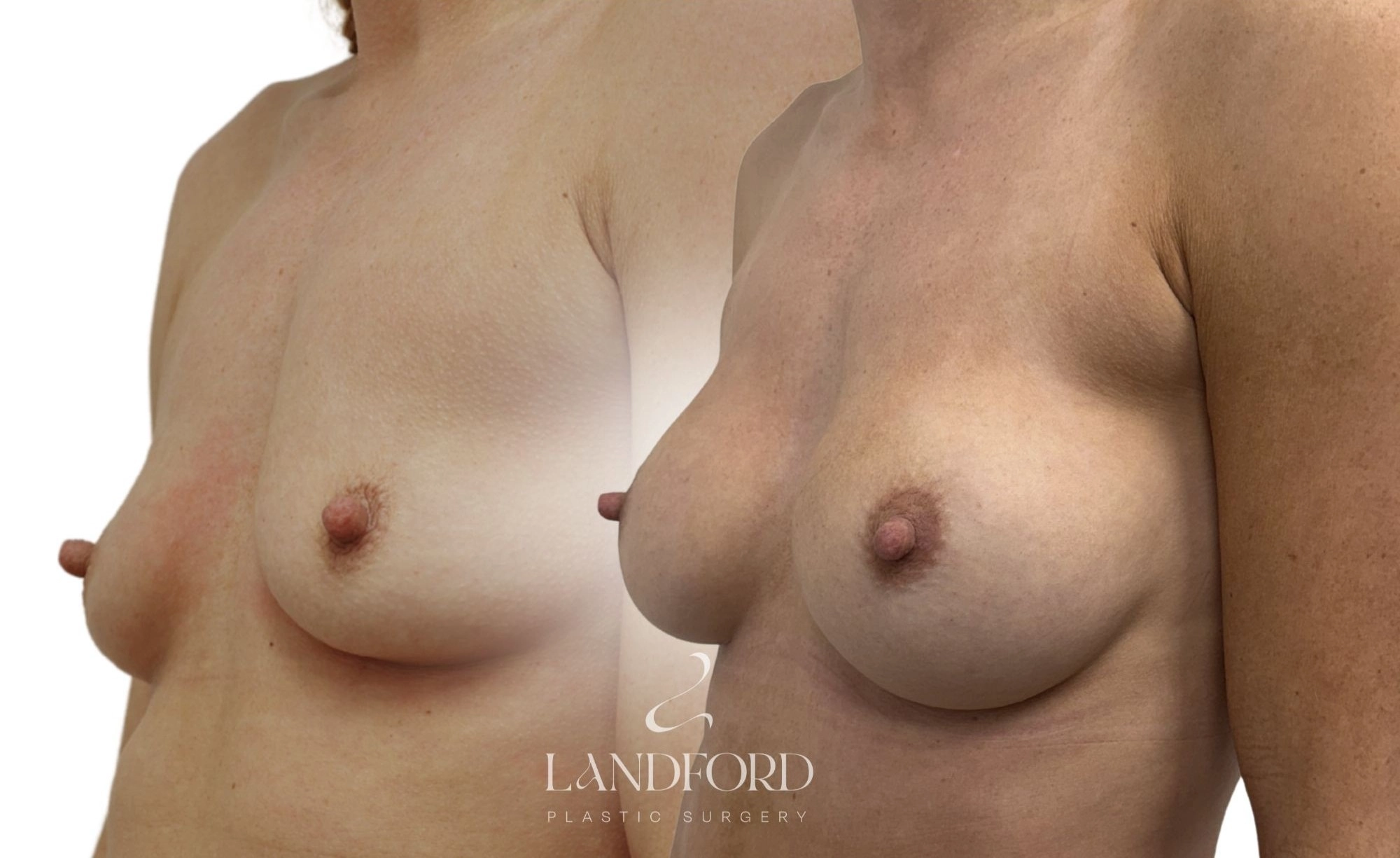 Breast Augmentation
