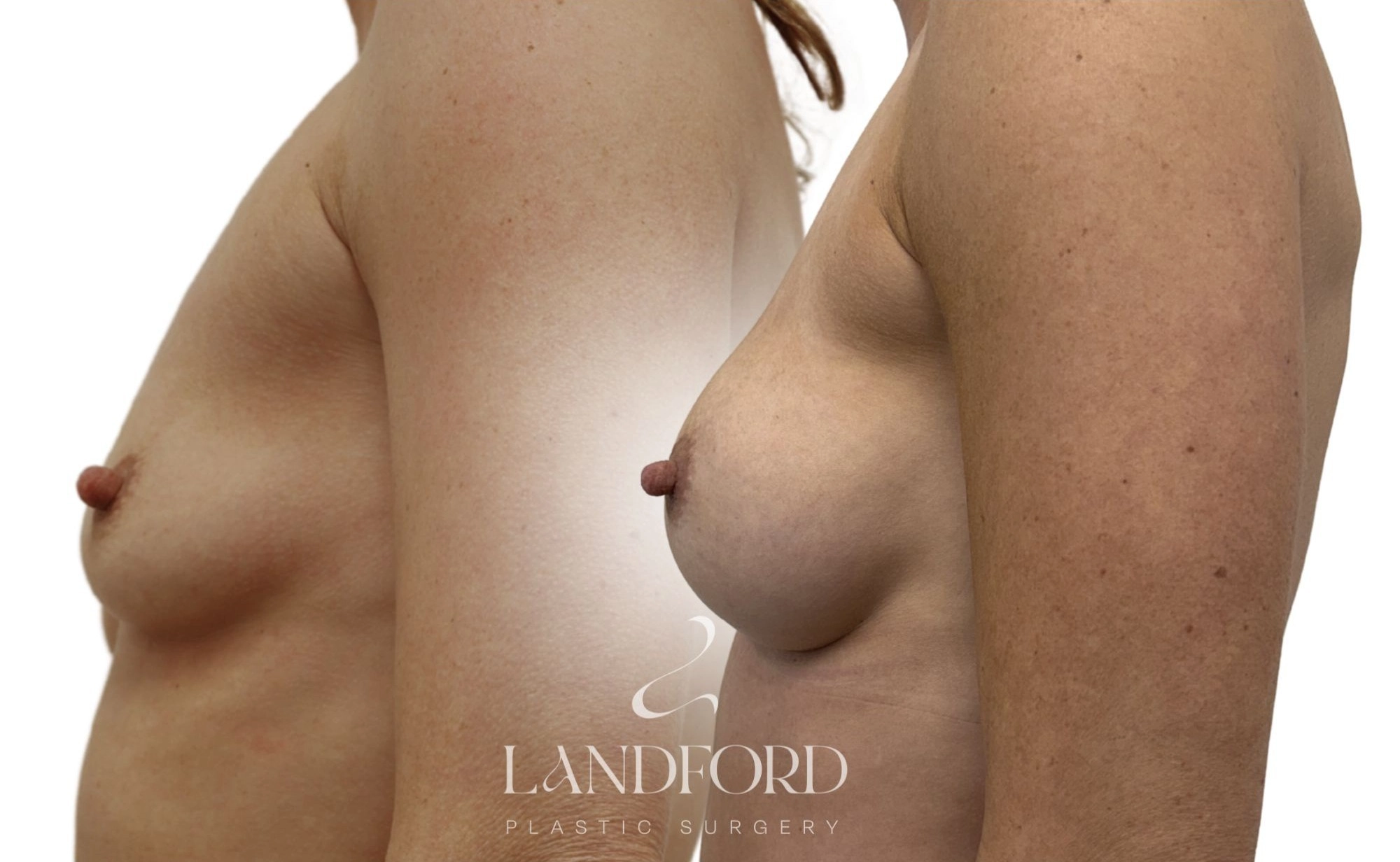 Breast Augmentation