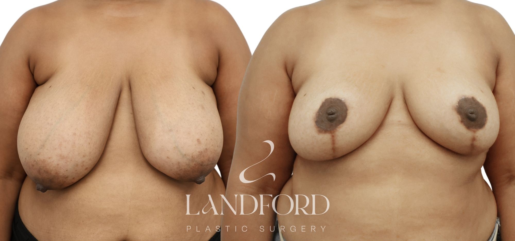 Breast Reduction
