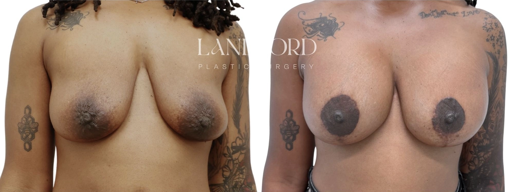 Breast Augmentation