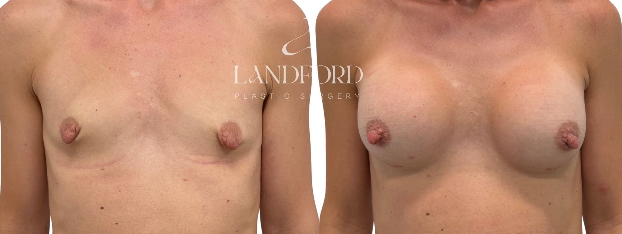 Breast Augmentation