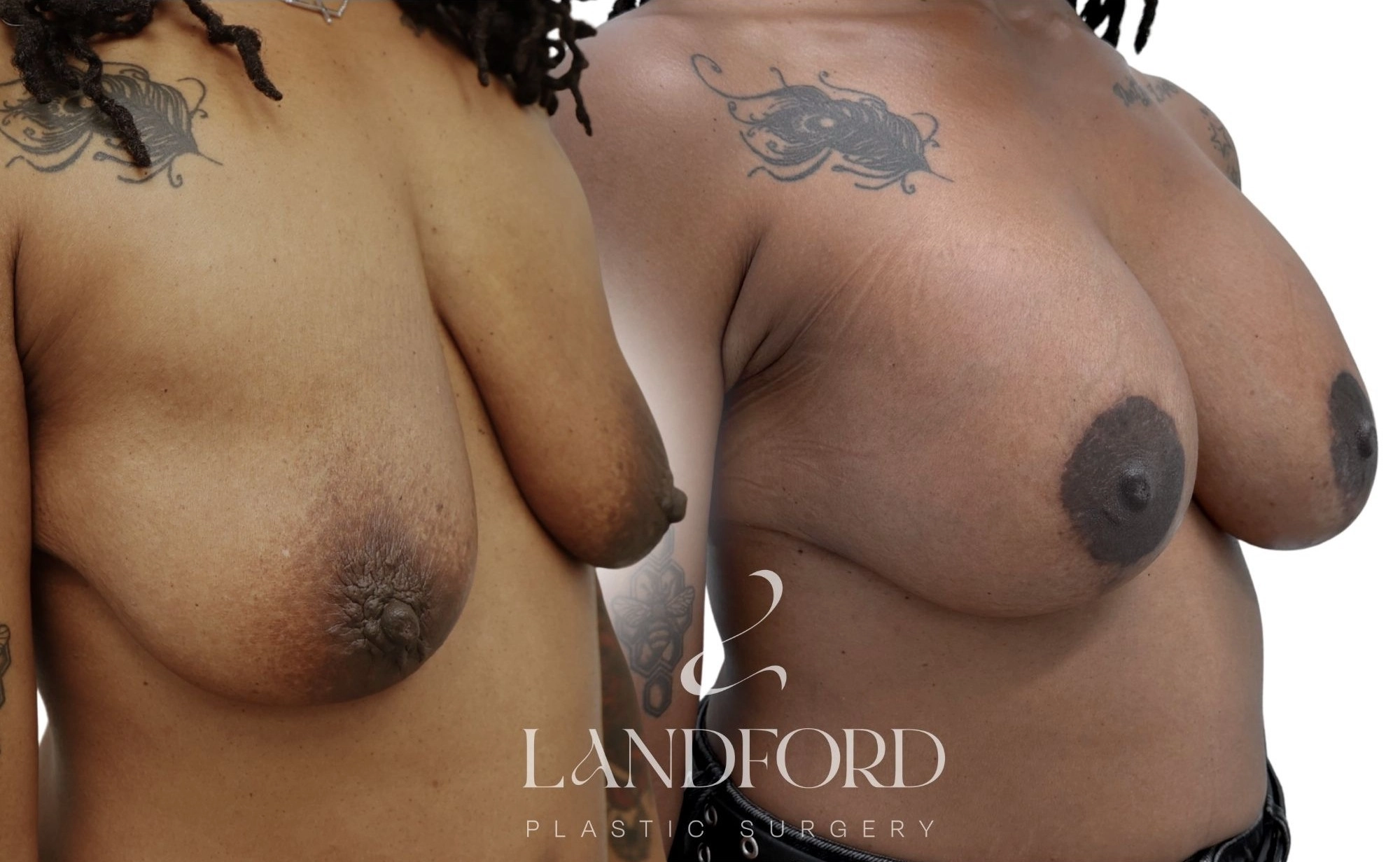Breast Augmentation