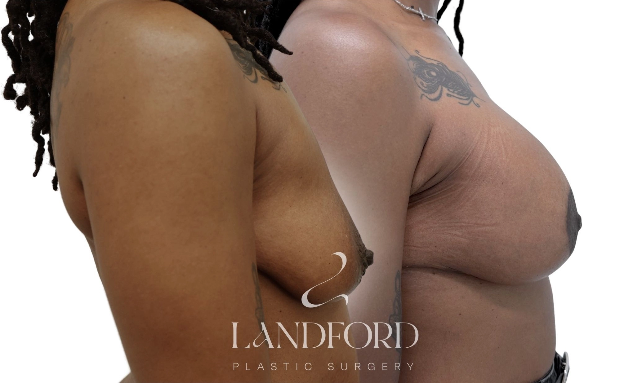 Breast Augmentation