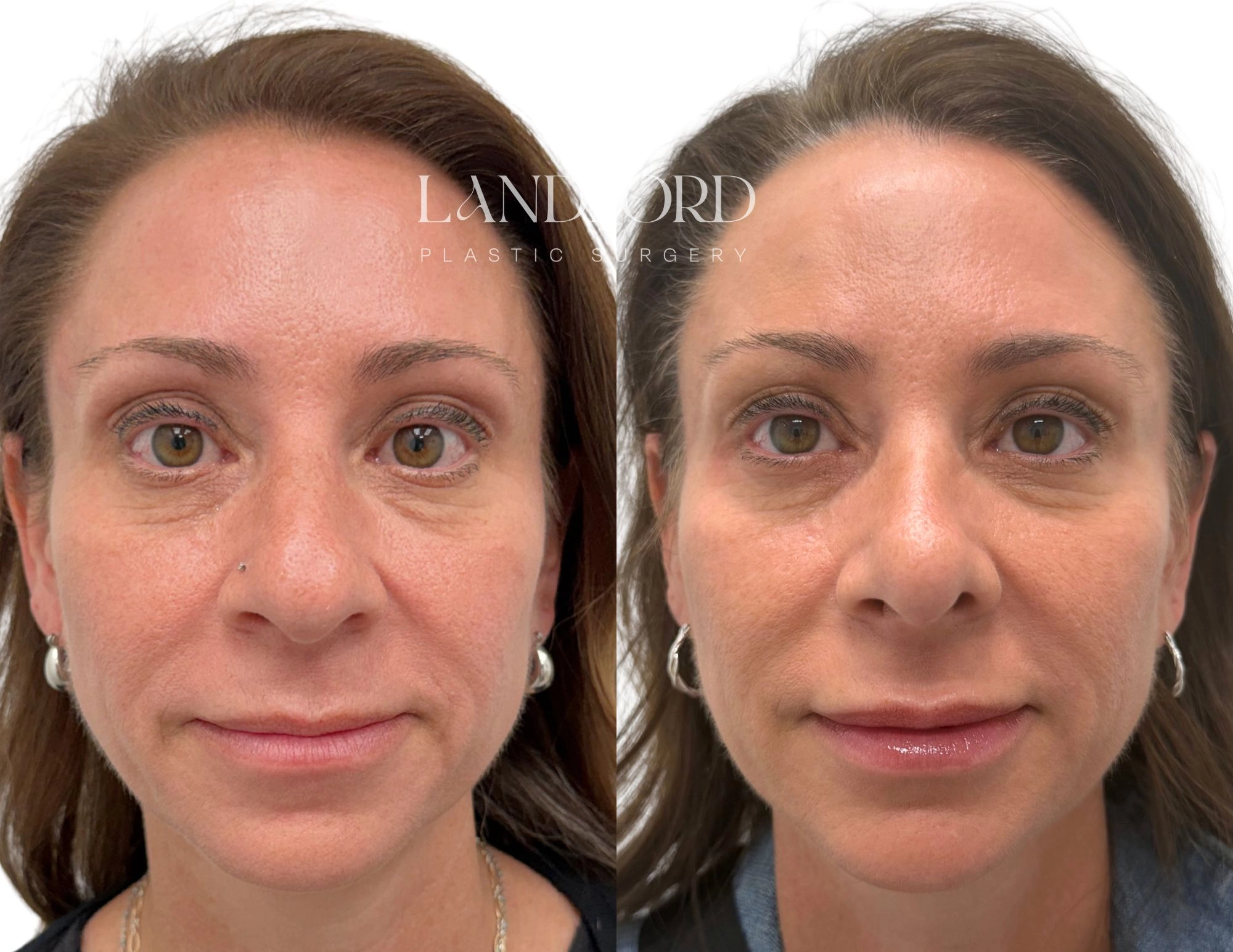 Rhinoplasty