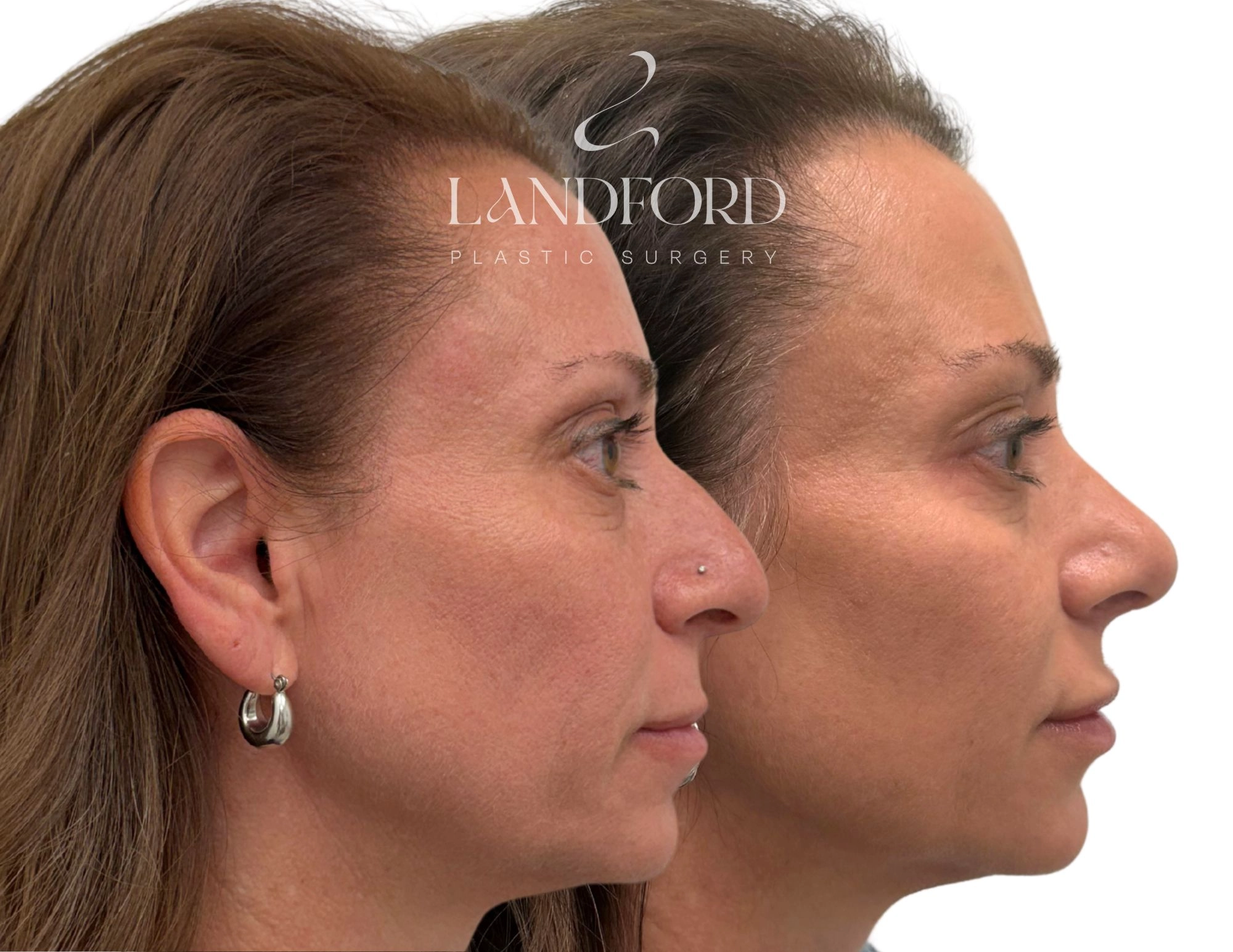 Rhinoplasty